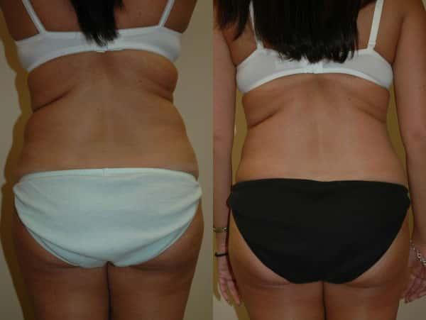 Liposuction result at Richard A. Bartlett M.D., P.C. in Brookline, MA