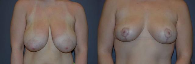 Breast Reduction result at Richard A. Bartlett M.D., P.C. in Brookline, MA