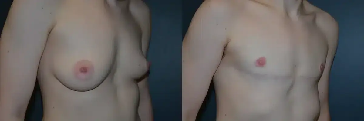 Richard A. Bartlett M.D., P.C. gender affirming top surgery result — Brookline, MA