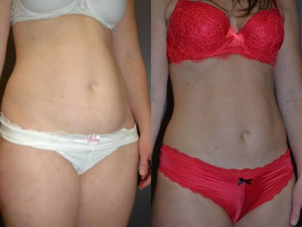 Richard A. Bartlett M.D., P.C. liposuction result — Brookline, MA
