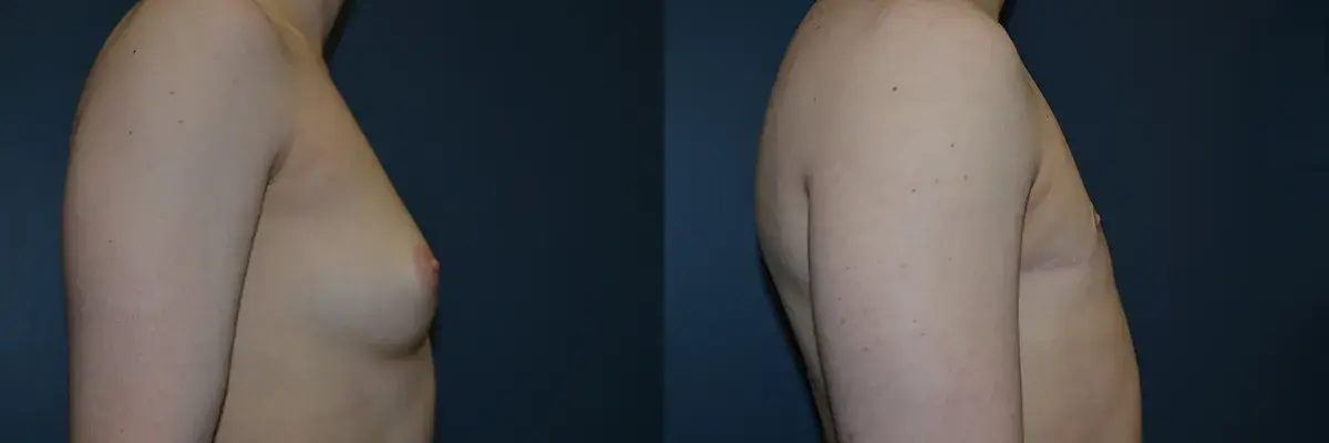 Richard A. Bartlett M.D., P.C. gender affirming top surgery result — Brookline, MA