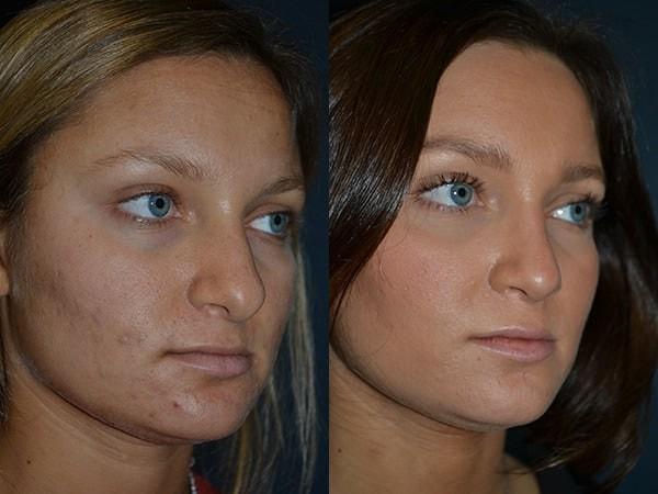 Richard A. Bartlett M.D., P.C. rhinoplasty result — Brookline, MA