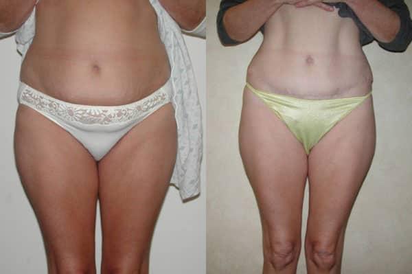 Tummy Tuck result at Richard A. Bartlett M.D., P.C. in Brookline, MA