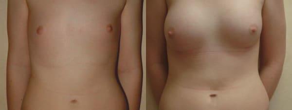Breast Augmentation result at Richard A. Bartlett M.D., P.C. in Brookline, MA