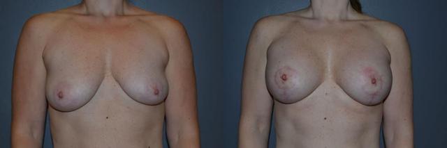 Breast Lift result at Richard A. Bartlett M.D., P.C. in Brookline, MA