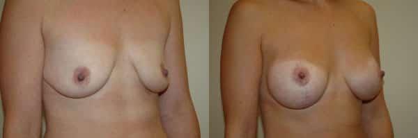 Breast Lift result at Richard A. Bartlett M.D., P.C. in Brookline, MA