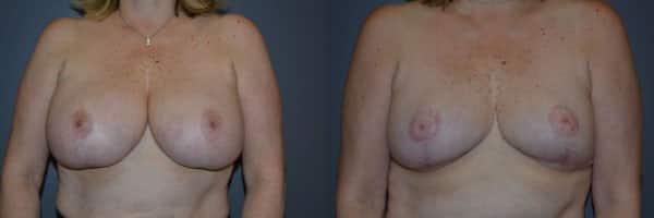 Breast Reduction result at Richard A. Bartlett M.D., P.C. in Brookline, MA
