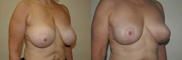 Breast Lift result at Richard A. Bartlett M.D., P.C. in Brookline, MA