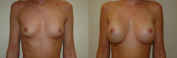 Breast Augmentation result at Richard A. Bartlett M.D., P.C. in Brookline, MA