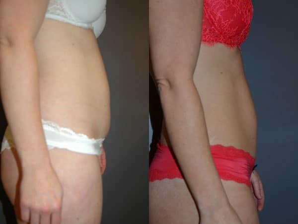 Liposuction result at Richard A. Bartlett M.D., P.C. in Brookline, MA