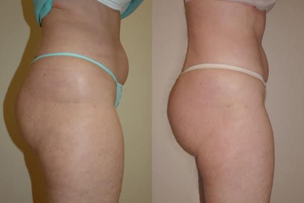 Richard A. Bartlett M.D., P.C. liposuction result — Brookline, MA