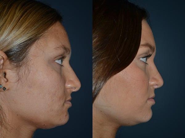 Richard A. Bartlett M.D., P.C. rhinoplasty result — Brookline, MA
