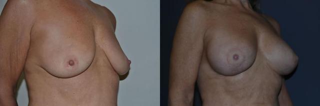 Breast Lift result at Richard A. Bartlett M.D., P.C. in Brookline, MA