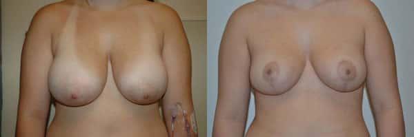Breast Reduction result at Richard A. Bartlett M.D., P.C. in Brookline, MA