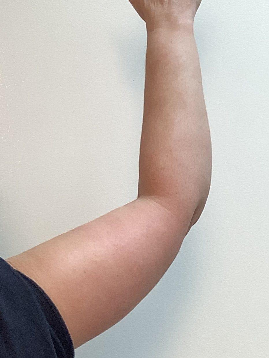 Cascade Cosmetic Surgery Center arm lift after — Orem, UT