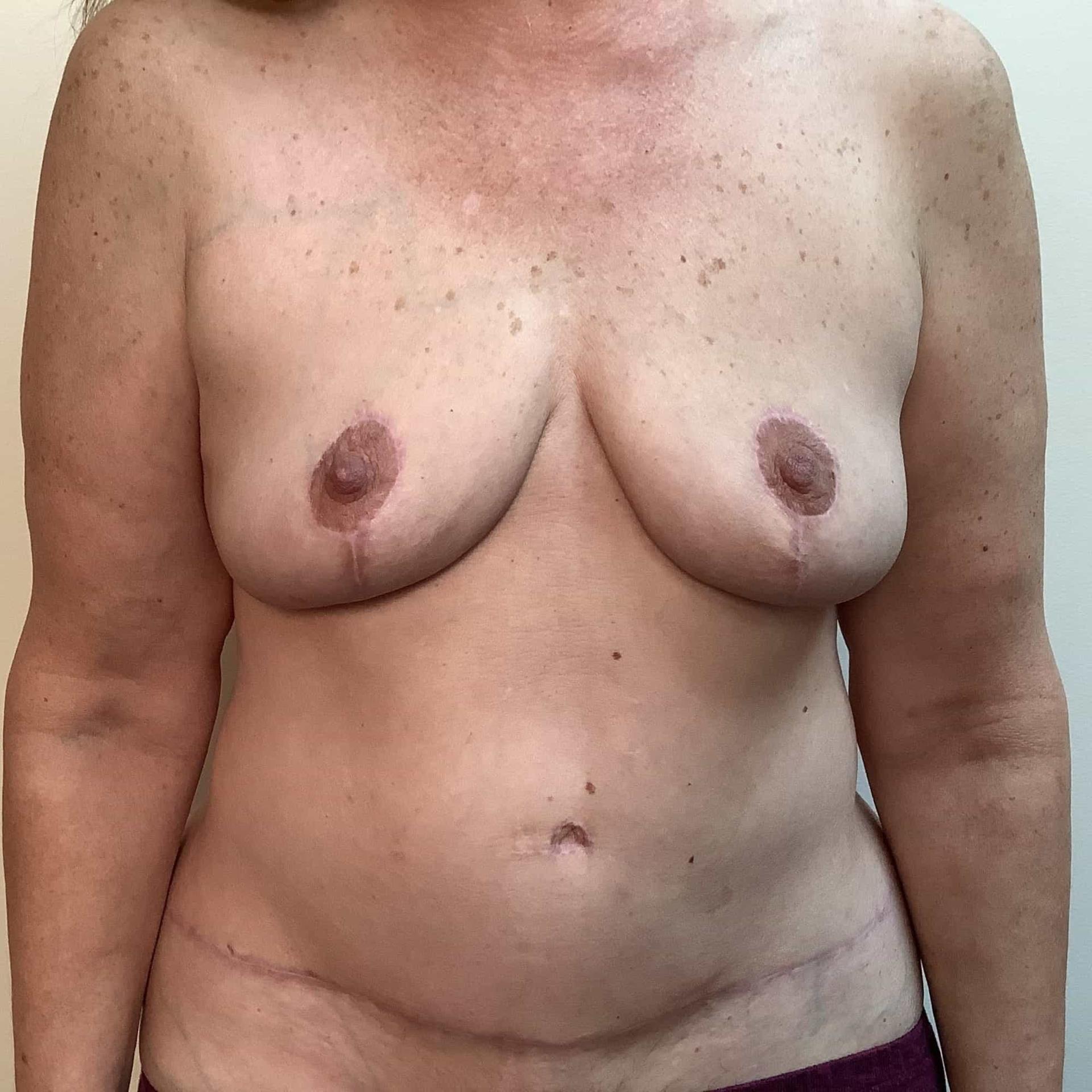 Cascade Cosmetic Surgery Center mommy makeover after — Orem, UT