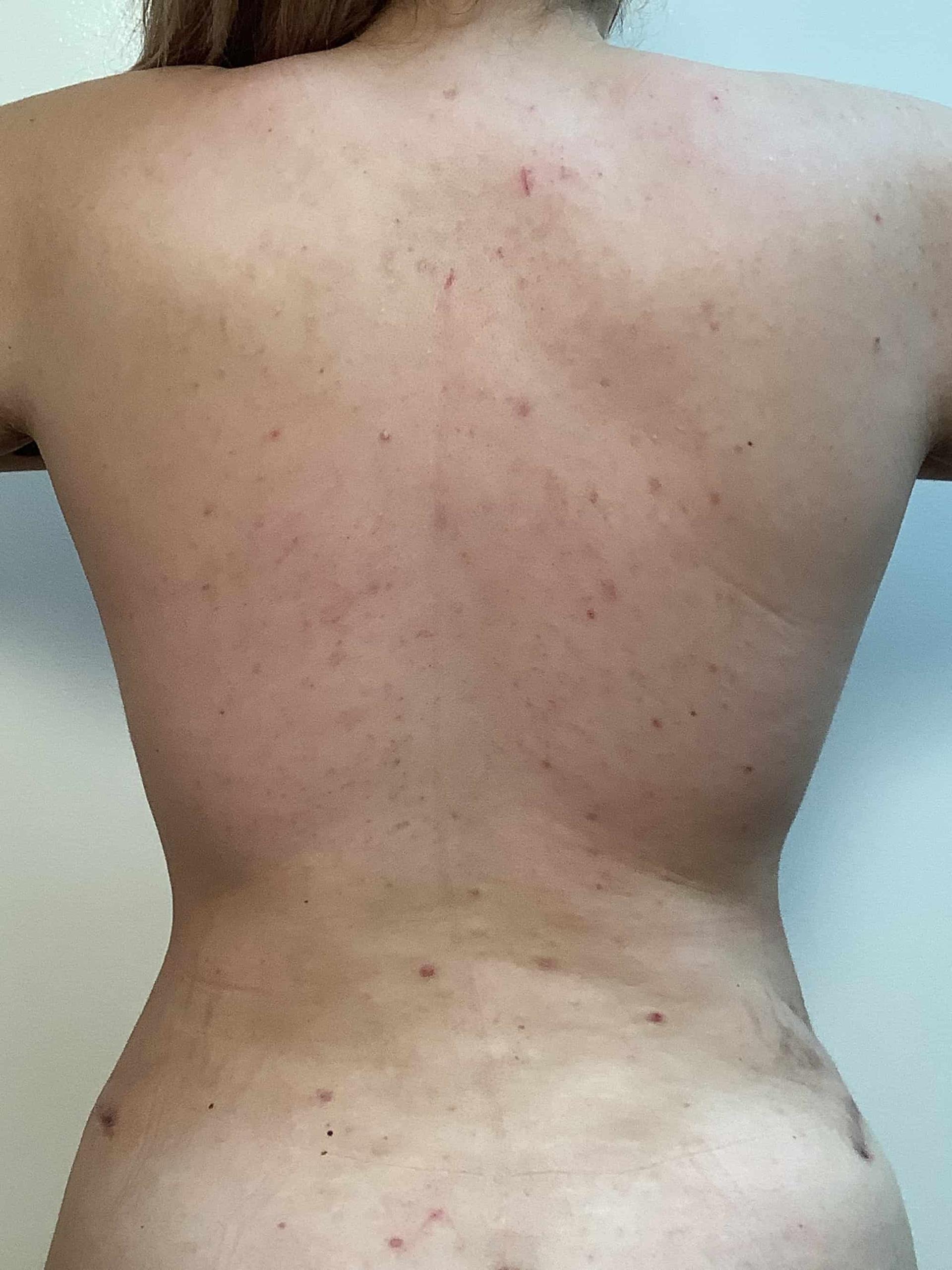 Cascade Cosmetic Surgery Center liposuction after — Salt Lake City, UT