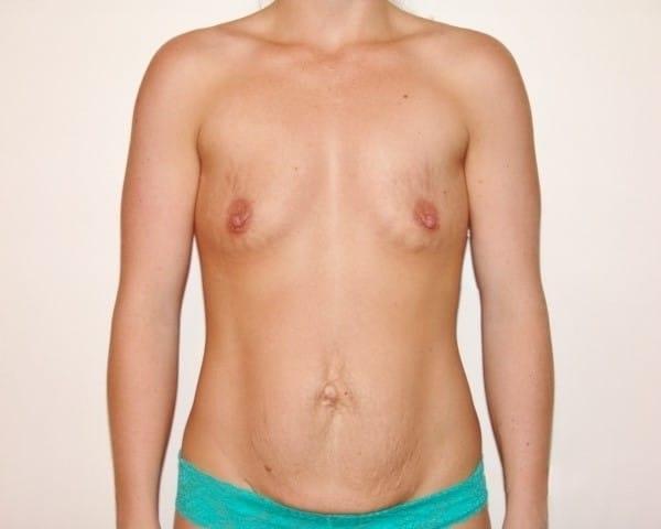 Mommy Makeover before at Cascade Cosmetic Surgery Center in Orem, UT