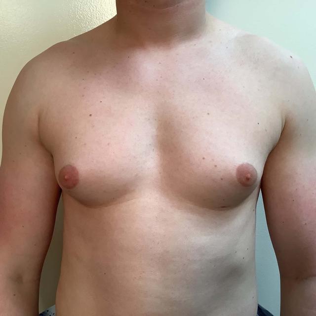 Gynecomastia Surgery before at Cascade Cosmetic Surgery Center in Salt Lake City, UT