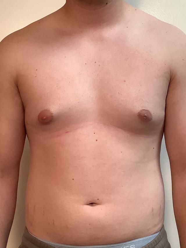 Gynecomastia Surgery before at Cascade Cosmetic Surgery Center in Orem, UT