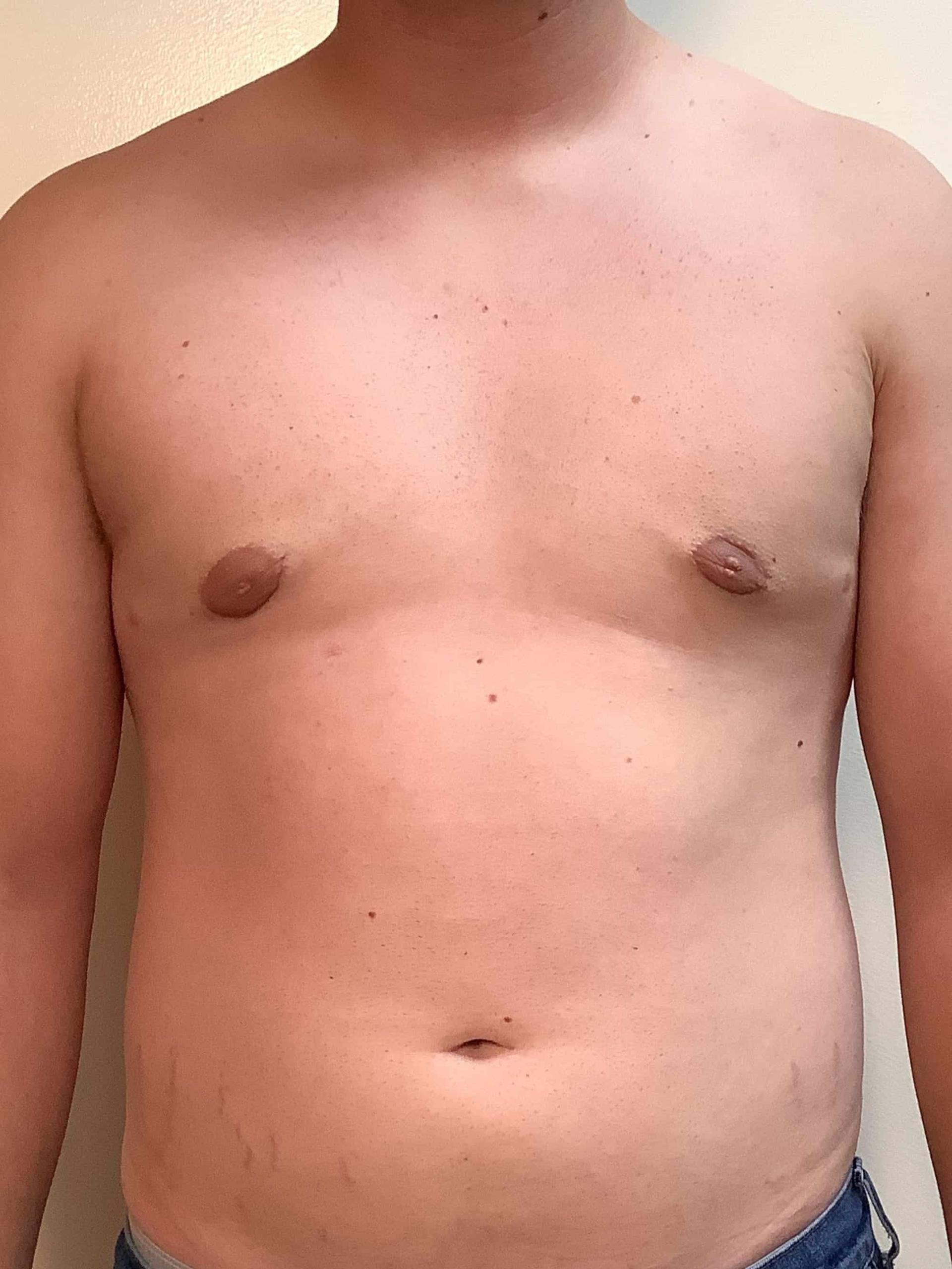 Cascade Cosmetic Surgery Center gynecomastia after — Orem, UT