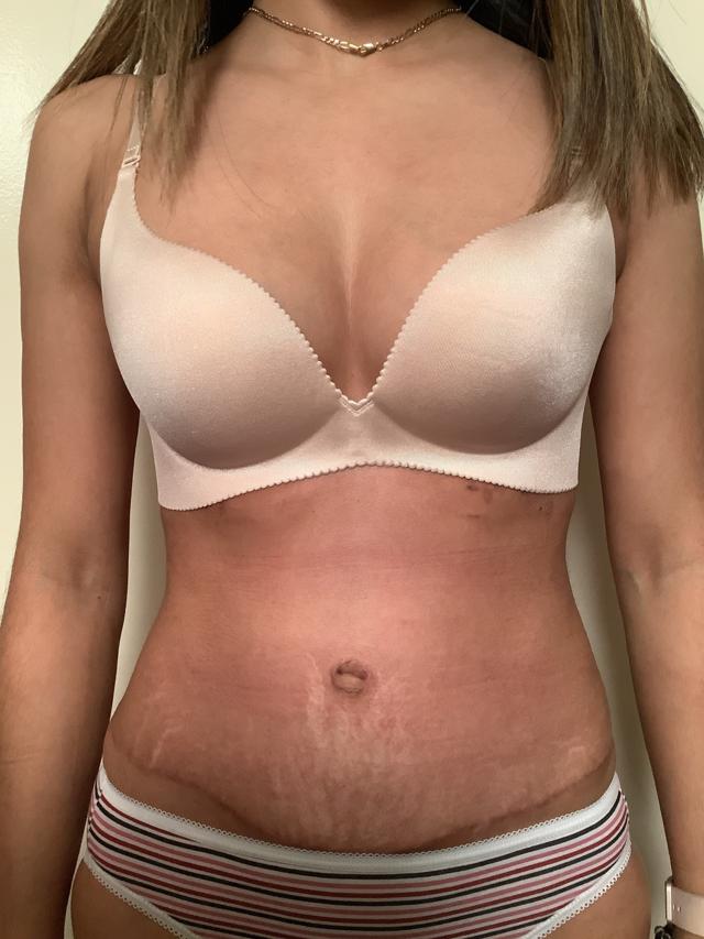 Mini Tummy Tuck after at Cascade Cosmetic Surgery Center in Orem, UT