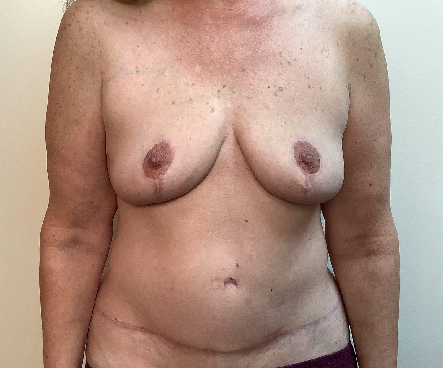 Cascade Cosmetic Surgery Center body contouring after — Orem, UT