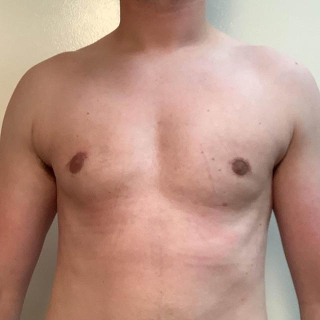 Gynecomastia Surgery after at Cascade Cosmetic Surgery Center in Salt Lake City, UT