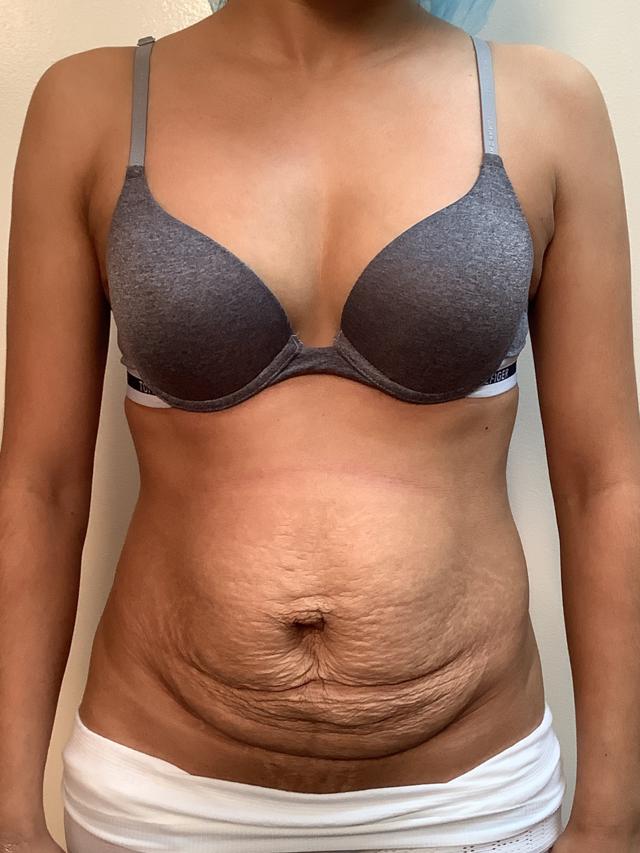 Mini Tummy Tuck before at Cascade Cosmetic Surgery Center in Orem, UT