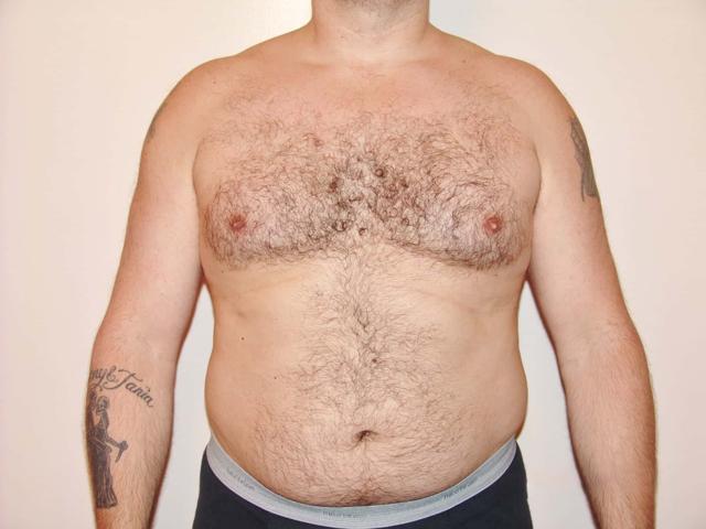 Liposuction before at Cascade Cosmetic Surgery Center in Orem, UT