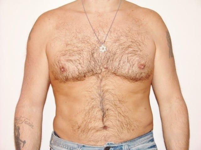 Liposuction after at Cascade Cosmetic Surgery Center in Orem, UT