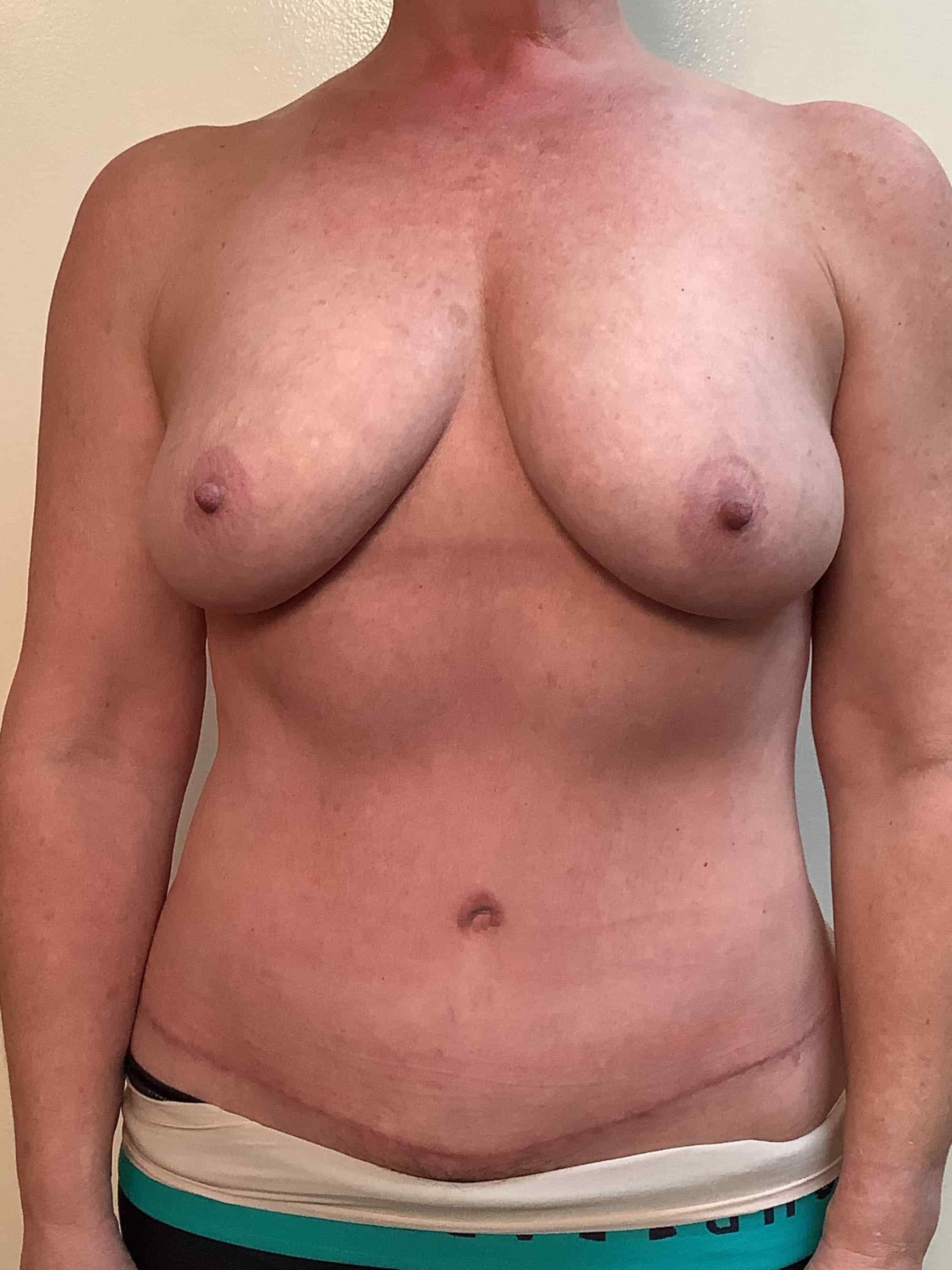Cascade Cosmetic Surgery Center tummy tuck after — Orem, UT