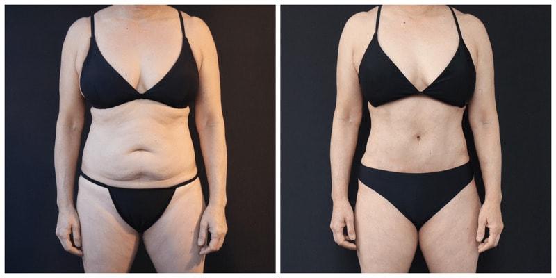 Sieber Plastic Surgery (David Sieber, MD) tummy tuck result — San Francisco, CA