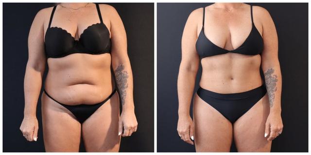 Mini Tummy Tuck result at Sieber Plastic Surgery (David Sieber, MD) in San Francisco, CA