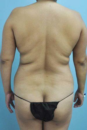 Liposuction before at Dr. Michael J. Sundine | Facial Aesthetic & Facial Reconstructive Surgery in Newport Beach, CA