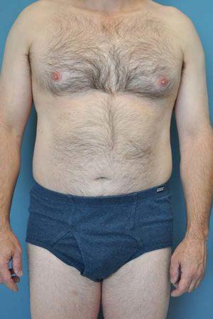 Gynecomastia Surgery after at Dr. Michael J. Sundine | Facial Aesthetic & Facial Reconstructive Surgery in Newport Beach, CA