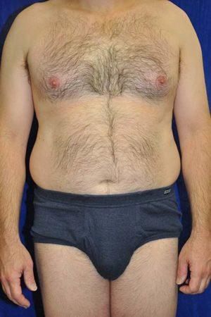 Gynecomastia Surgery before at Dr. Michael J. Sundine | Facial Aesthetic & Facial Reconstructive Surgery in Newport Beach, CA