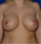 Breast Augmentation after at Dr. Michael J. Sundine | Facial Aesthetic & Facial Reconstructive Surgery in Newport Beach, CA