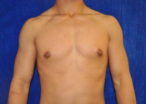 Gynecomastia Surgery after at Dr. Michael J. Sundine | Facial Aesthetic & Facial Reconstructive Surgery in Newport Beach, CA