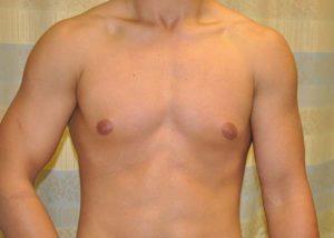Gynecomastia Surgery before at Dr. Michael J. Sundine | Facial Aesthetic & Facial Reconstructive Surgery in Newport Beach, CA