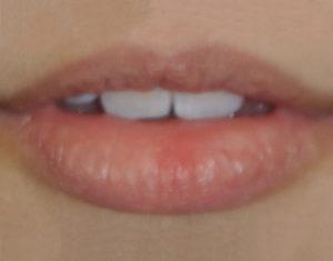 Lip Filler after at Dr. Michael J. Sundine | Facial Aesthetic & Facial Reconstructive Surgery in Newport Beach, CA