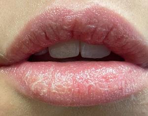 Lip Filler before at Dr. Michael J. Sundine | Facial Aesthetic & Facial Reconstructive Surgery in Newport Beach, CA