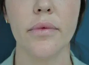 Lip Filler after at Dr. Michael J. Sundine | Facial Aesthetic & Facial Reconstructive Surgery in Newport Beach, CA