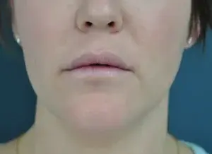 Lip Filler before at Dr. Michael J. Sundine | Facial Aesthetic & Facial Reconstructive Surgery in Newport Beach, CA