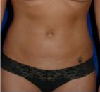 Liposuction after at Dr. Michael J. Sundine | Facial Aesthetic & Facial Reconstructive Surgery in Newport Beach, CA