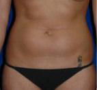 Liposuction before at Dr. Michael J. Sundine | Facial Aesthetic & Facial Reconstructive Surgery in Newport Beach, CA