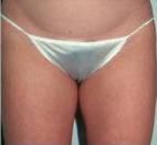 Liposuction after at Dr. Michael J. Sundine | Facial Aesthetic & Facial Reconstructive Surgery in Newport Beach, CA