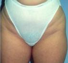 Liposuction before at Dr. Michael J. Sundine | Facial Aesthetic & Facial Reconstructive Surgery in Newport Beach, CA