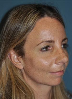 Rhinoplasty after at Dr. Michael J. Sundine | Facial Aesthetic & Facial Reconstructive Surgery in Newport Beach, CA
