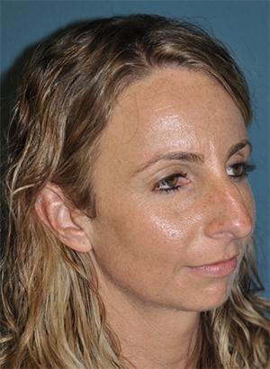 Rhinoplasty before at Dr. Michael J. Sundine | Facial Aesthetic & Facial Reconstructive Surgery in Newport Beach, CA